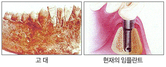 왼쪽이미지 : 고대/오른쪽이미지:현재의임플란트