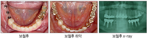 보철후 > 보철후 하악 > 보철후 x-ray