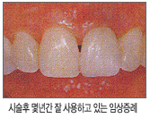 시술후 몇년간 잘 사용하고 있는 임상증례