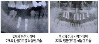 왼쪽:2개의 빠진 치아에 2개의 임플란트를 식립한 모습/오른쪽:위턱의 전체 치아가 없어 8개의 임플란트를 식립한 모습