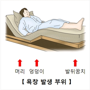 욕창의 발생 기전