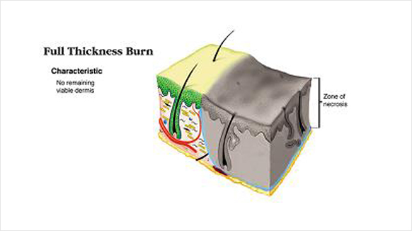 full thickness burn