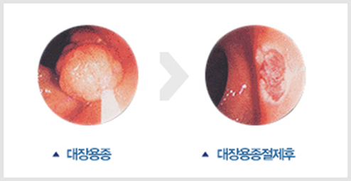 수면 대장내시경 검사는 이렇게