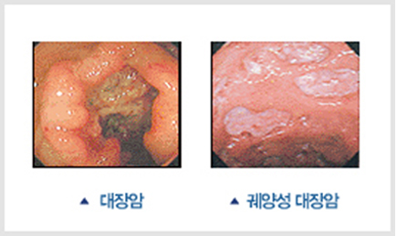 수면 대장내시경 검사는 이렇게